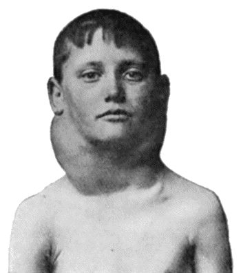 Fig. 80.—Chronic Hodgkin's Disease in a boy æt. 11.