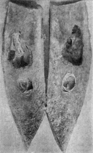 Fig. 120.—Segment of Tibia resected for Brodie's Abscess. The specimen shows two separate abscesses in the centre of the shaft, the lower one quiescent, the upper one active and increasing in size.