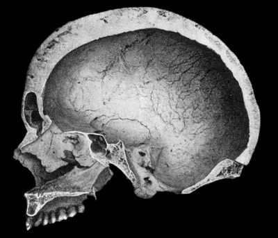 Fig. 134.—Changes in the Skull resulting from Ostitis Deformans. (Anatomical Museum, University of Edinburgh.)