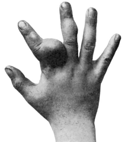 Fig. 144.—Multiple Chondromas in Hand of boy æt. 8
